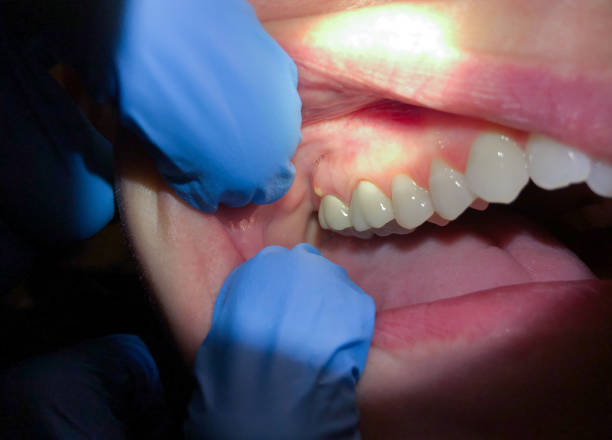 Best Dental Abscess Treatment in Southern View, IL